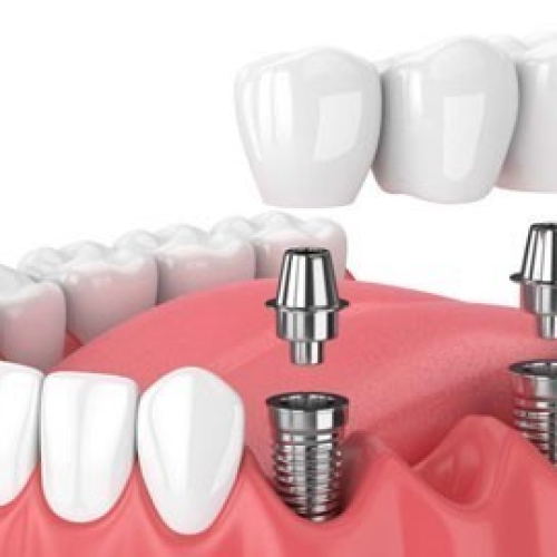 Cấy Ghép Implant